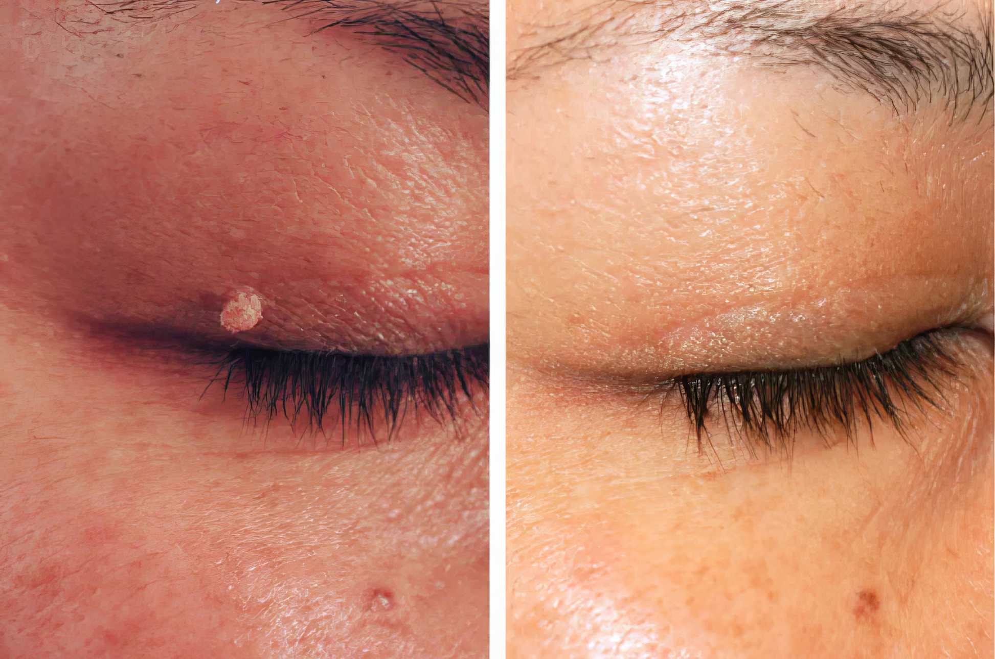 LumiClear™ – Removedor de Verrugas Avanzado