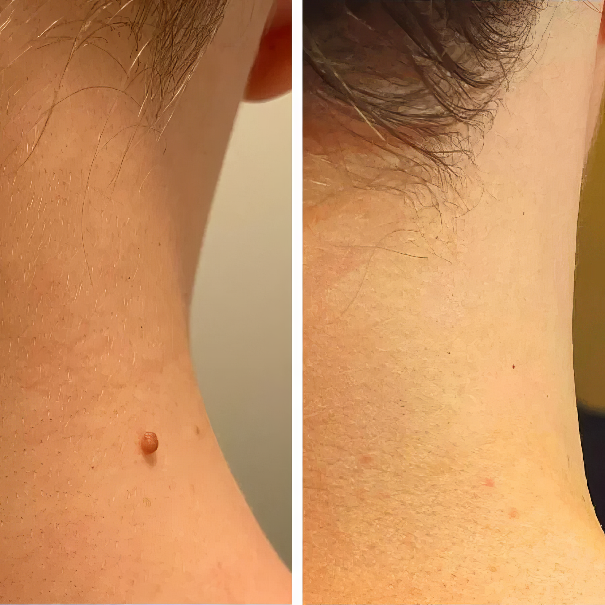 LumiClear™ – Removedor de Verrugas Avanzado