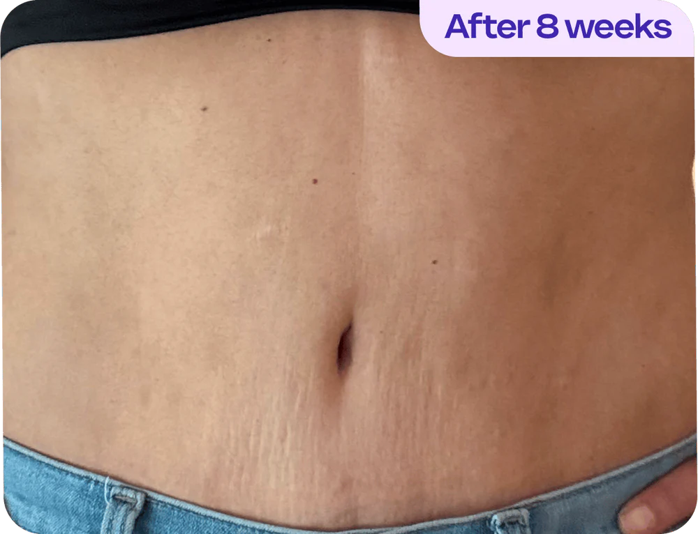 LumiFirm™ – Crema Antiestrías & Reafirmante Vientre