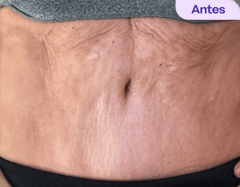 GoPure By Lumi– Crema Antiestrías & Reafirmante Vientre
